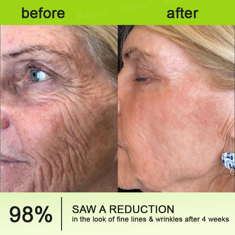 ☘️✨Made and shipped from Canada 💫Rolimey® Botox & Vita-A Retinol Shot Wrinkle-Lift Tightening cream - Last Day Promotion 70% OFF