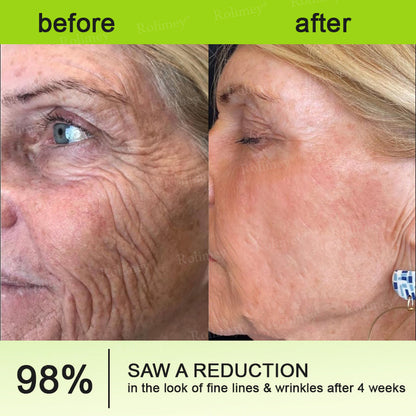 ☘️✨Made and shipped from Canada 💫Rolimey® Botox & Vita-A Retinol Shot Wrinkle-Lift Tightening cream - Last Day Promotion 70% OFF